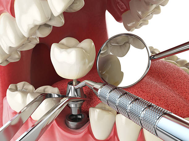 Best Emergency Dental Care for Abscessed Tooth in Forsyth, MO